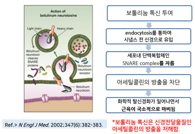 약수역치과, 턱관절 관련 질환(보톡스 치료) 관련 이미지 1