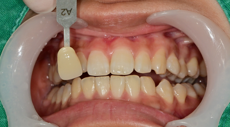 약수역 치과, 치아 미백 1회 방문으로 효과가 있을까?(feat. 원데이 미백) 관련 이미지 5