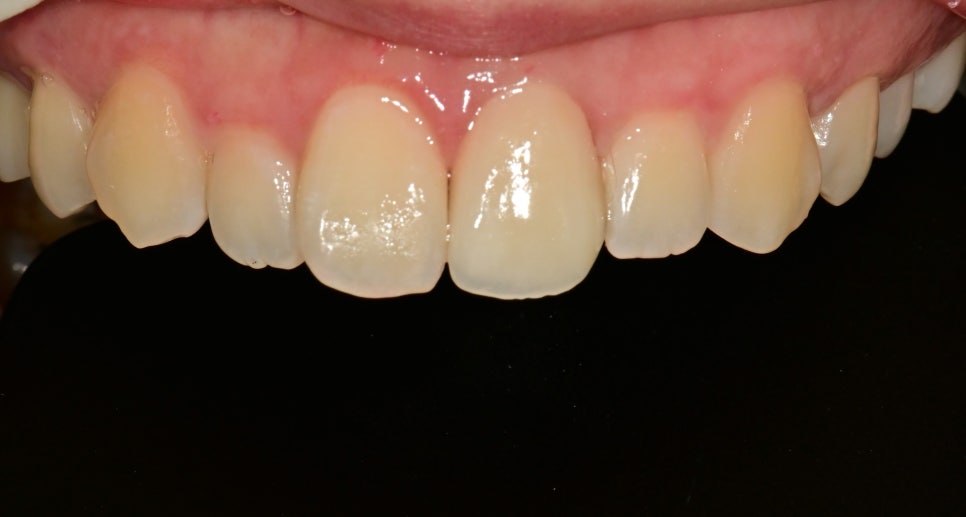 한남동 주변 치과 외상에 의해 앞니가 깨졌을 때 범위에 따른 치료방법 관련 이미지 2