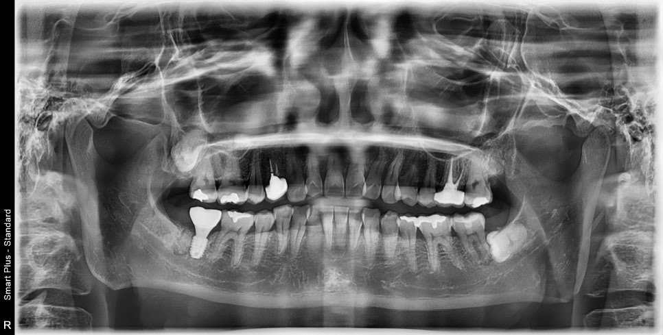 약수역 치과, 금 간 치아( 크랙 치아)로 인한 뿌리 주변 염증이 생겼을 때 치료방법( 임플란트, 치조골 이식술) 관련 이미지 6