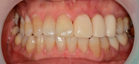 약수역 치과 오래된 앞니 크라운 재보철치료시 주의할 사항 관련 이미지 3