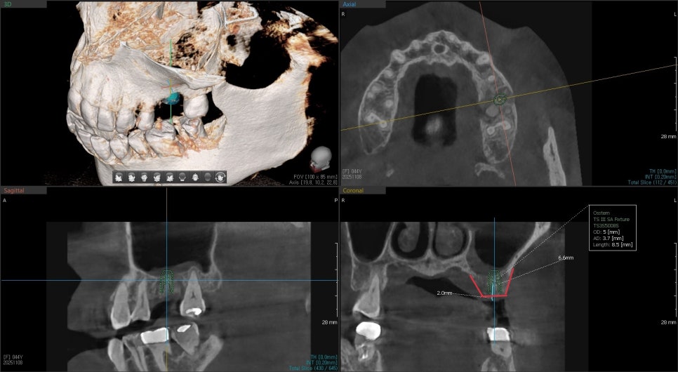 약수역 임플란트, 발치 후 임플란트 수술 언제 가능한가? 관련 이미지 6