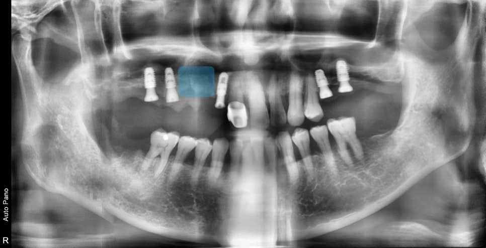 신당역 임플란트 풍치, 심한 치주염인 경우 치과에서 치료 순서 관련 이미지 5