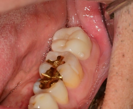 장충동 치과, MTA를 이용한 신경치료 시 주의할 점( 크랙치아, 깊은 충치) 관련 이미지 10