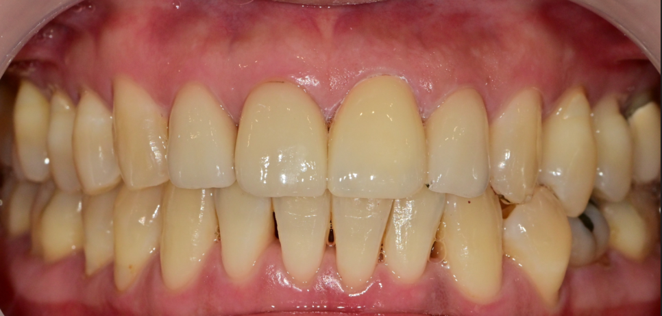 약수역 치과, 전치부 심미 보철 재치료(보철물 파절의 원인) 관련 이미지 7