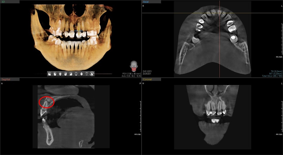신당동 치과, 앞니 보철치료시 주의할 점(심미보철, 신경치료) 관련 이미지 4