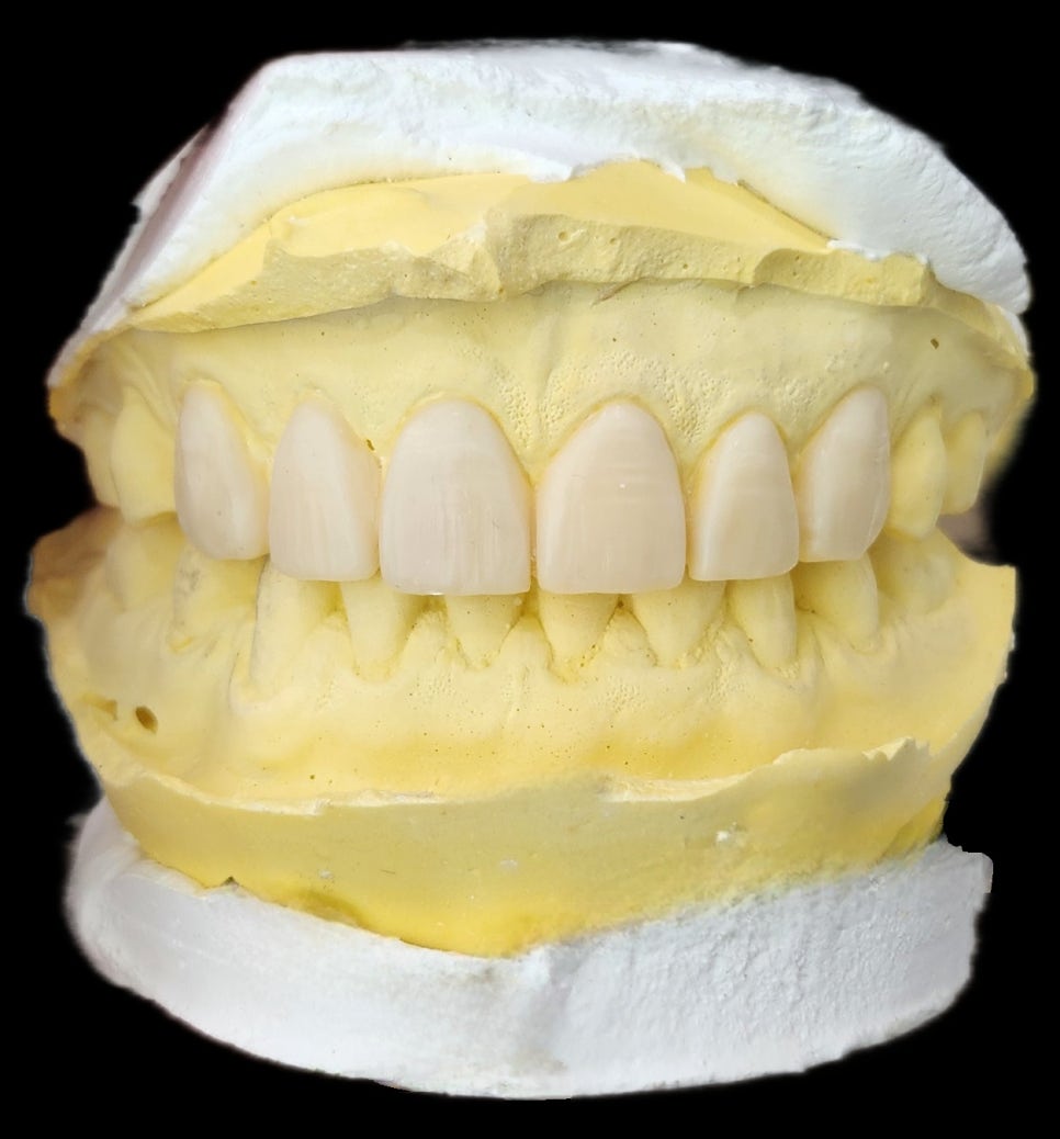 신당동치과 심미보철을 이용한 고른 앞니 만들기 관련 이미지 3