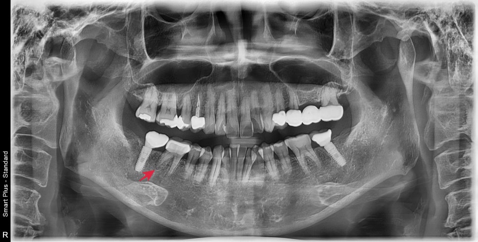 옥수동 크라운치료된 통증 있는 치아의 (재)신경치료 과정 관련 이미지 2