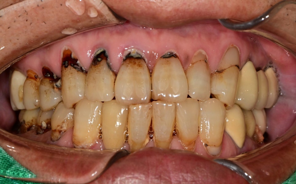 옥수동 치과 앞니 충치가 생기는 원인, 치료방법 (심미치료, 레진) 관련 이미지 2