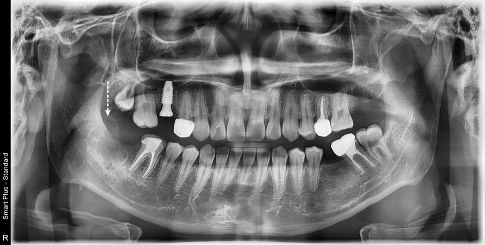 금호동 논골사거리 근처 치과에서 영구치 치료를 위한 잇몸성형술 관련 이미지 4