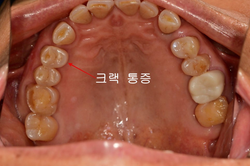 신당동 치과 씹을 때마다 아플 때 임플란트 치아의 문제 관련 이미지 2