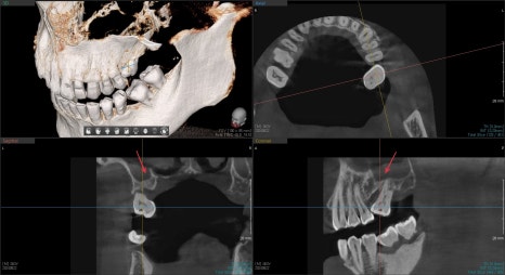 신당동 치과 오래전 빠진 치아 상태에서 임플란트 수술(상악동 거상술) 관련 이미지 8