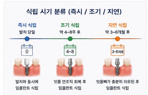 약수역 치과 발치후 임플란트 식립시기는 어떻게 정해질까요? 관련 이미지 3
