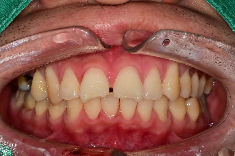 버티고개역 치과 앞니 외상에 따른 치료방법( 넘어져서 치아가 부러졌어요) 관련 이미지 3