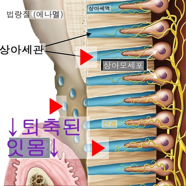 약수역 치과, 치경부마모증 치아에는 어떤 치료를 해야될까요??(시린이 치아의 원인과 해결방법) 관련 이미지 2