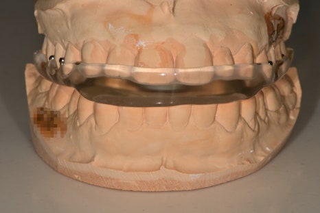 동대입구역 치과 이갈이 장치 제작이 필요한 경우(턱관절 통증) 관련 이미지 3