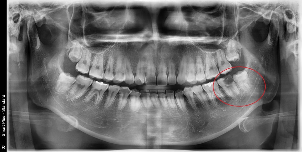 청구역 치과, 충치가 생긴 치아를 초기에 치료를 미루면 안되는 이유!! ( 신경염증, 뿌리주변 염증, 보철치료를 위한 사랑니 발치) 관련 이미지 1