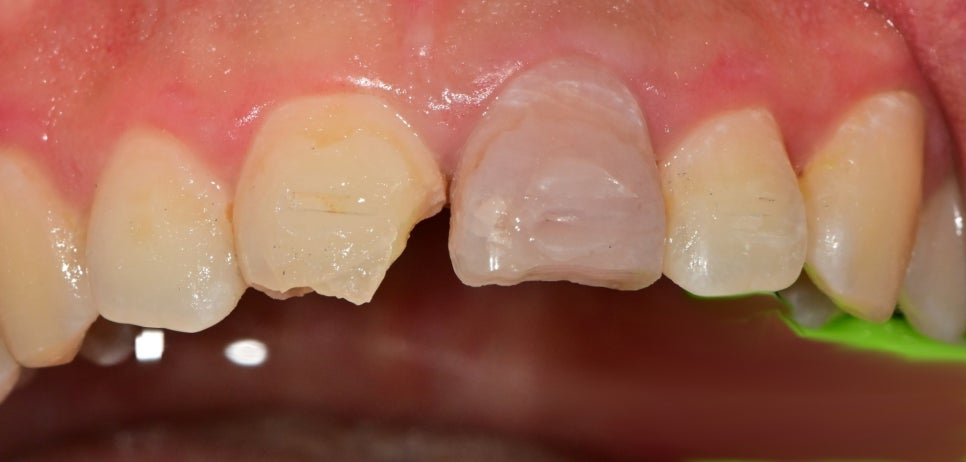 버티고개역 치과 앞니 외상에 따른 치료방법( 넘어져서 치아가 부러졌어요) 관련 이미지 8