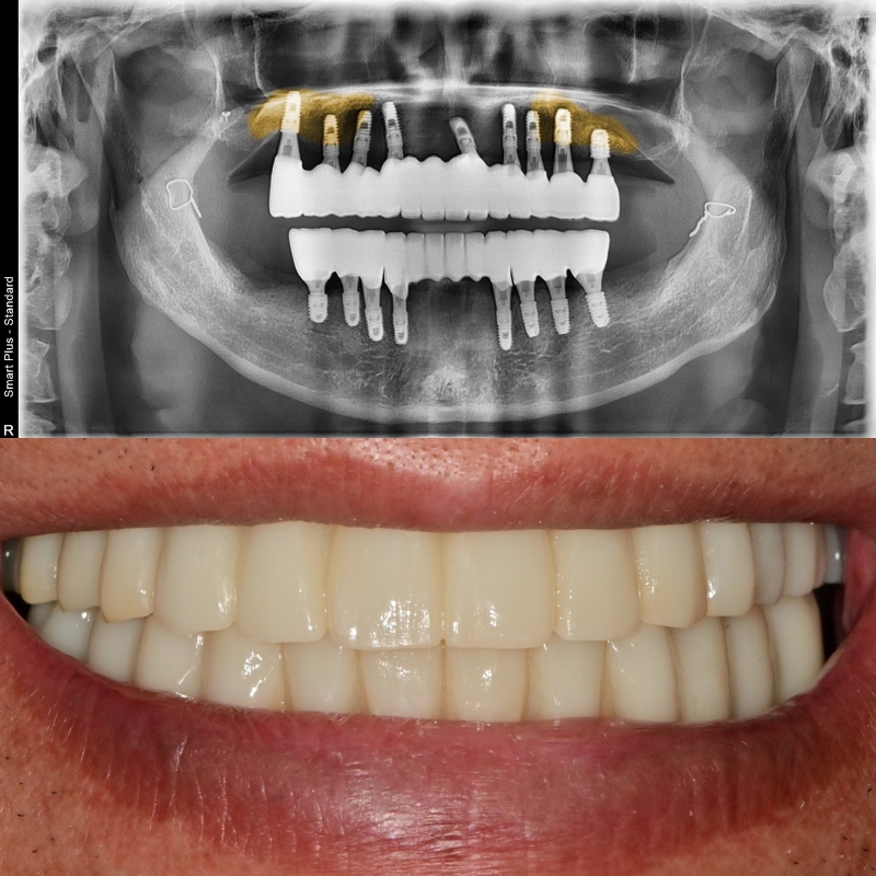 약수역치과 전체임플란트 진행과정 (상악동 거상술) 관련 이미지 7