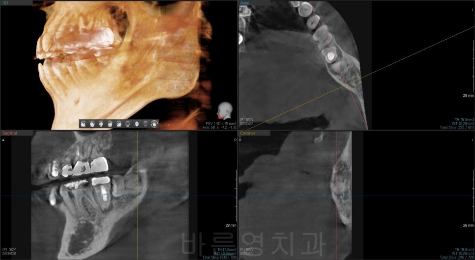 신당역 치과, 임플란트를 수술을 위해 사랑니는 꼭 빼야 하나요?? (얼마나 기다려야 임플란트 치료가 가능한가요?) 관련 이미지 2