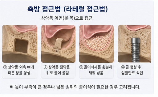 Yak-su Station Dental Clinic: When Is a Sinus Lift Necessary for Implants? image 6