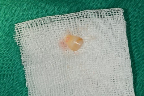 약수역 치과 크랙 치아 (금 간 치아) 관련 이미지 2