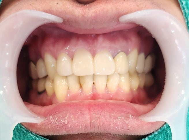 신당동 치과, 앞니 보철치료시 주의할 점(심미보철, 신경치료) 관련 이미지 6