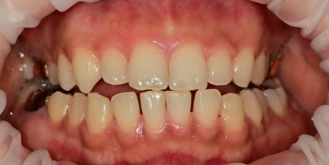 약수역치과 벌어진 앞니(치간이개) 레진을 이용한 치료방법 관련 이미지 3