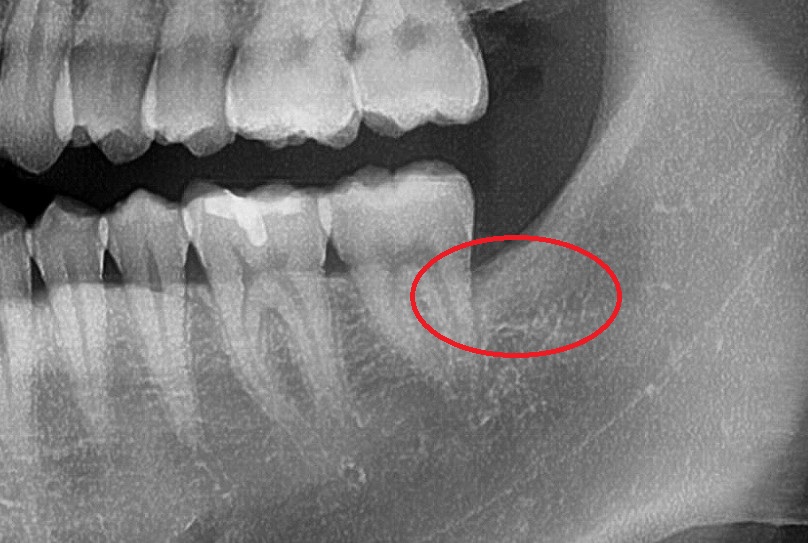 금호동 치과, 사랑니 때문에 주변 잇몸이 붓는 이유 (매복 사랑니 주변 치은염) 관련 이미지 4