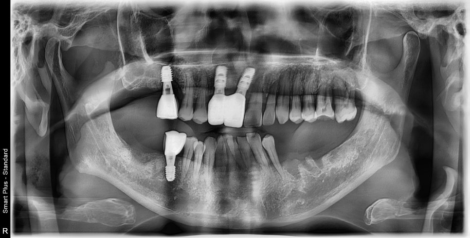 청구역 치과 치주염으로 다수의 치아가 흔들리는 경우(발치, 임플란트) 관련 이미지 11