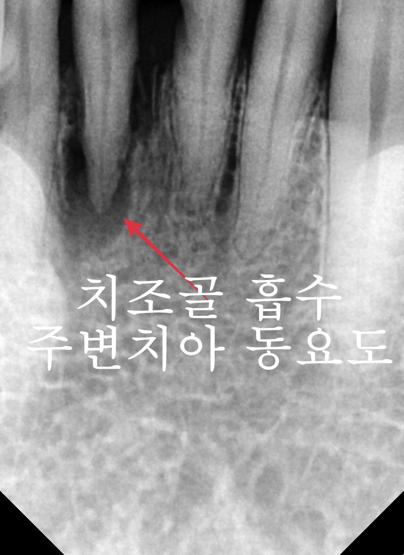 성동구 옥수동 치과 앞니 임플란트수술 즉시 임시치아 제작(구강스캐너를 이용한 수술절차) 관련 이미지 3