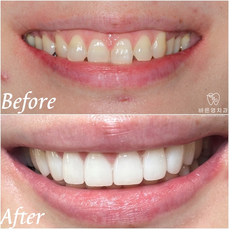 신당 라미네이트 치과 미세삭제로 예쁜 미소 만들기 관련 이미지 4