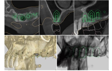 신당 임플란트, 심을까 말까 고민되신다면?? (고난도 골이식 임플란트 기간 및 통증) 관련 이미지 7