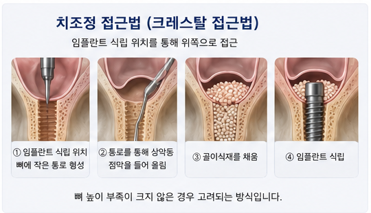 Yak-su Station Dental Clinic: When Is a Sinus Lift Necessary for Implants? image 5