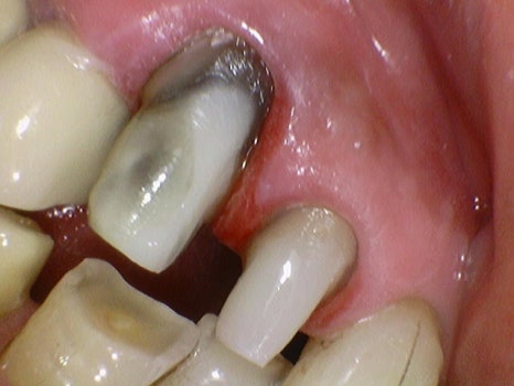 금호역 치과, 오래된 크라운을 교체 시기와 교체 시 주의해야 할 사항( 2차 충치로 인한 약해진 치아 치료) 관련 이미지 3