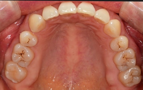 동대문 무삭제라미네이트 과거 교정한 치아가 웃을 때 안 보여 스트레스일 때 관련 이미지 2