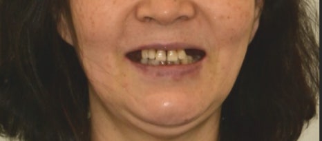 약수동 치과, 광범위한 뼈이식 임플란트 수술 후 회복 과정 관련 이미지 9