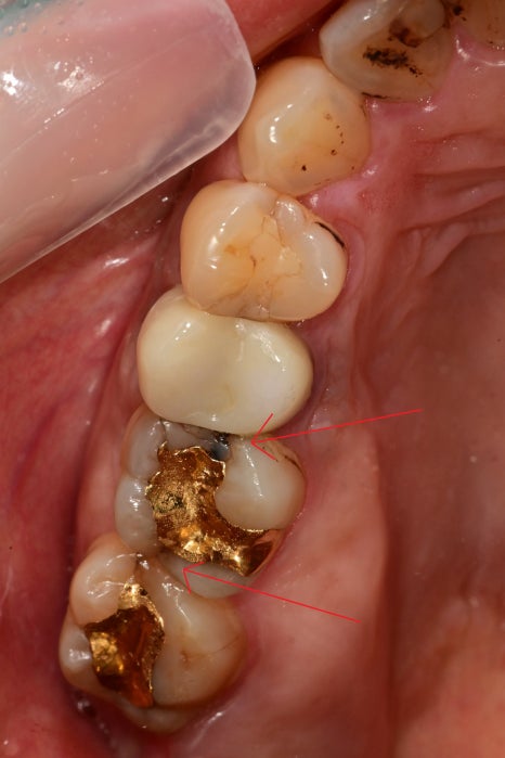 약수역 치과, 금간 치아는 신경치료를 꼭 해야 하나요?( 임플란트 전 크라운치료, MTA) 관련 이미지 2