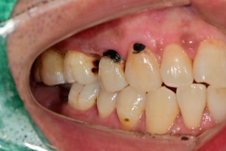 장충동 주변 치과 오래된 충치, 빠진 치아 부위 치료 방법 관련 이미지 2