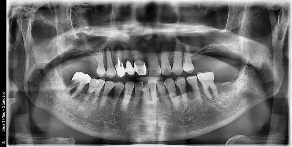 신당역 임플란트 풍치, 심한 치주염인 경우 치과에서 치료 순서 관련 이미지 1