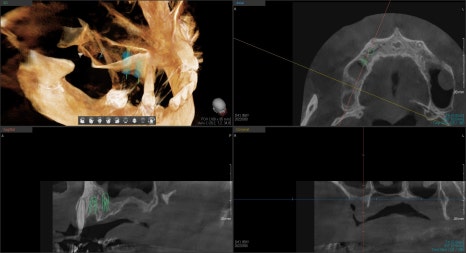 약수역치과 전체임플란트 진행과정 (상악동 거상술) 관련 이미지 4