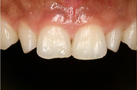 청구동 치과 앞니 라미네이트를 하는 이유 관련 이미지 1