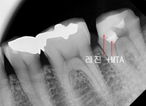장충동 치과, MTA를 이용한 신경치료 시 주의할 점( 크랙치아, 깊은 충치) 관련 이미지 9