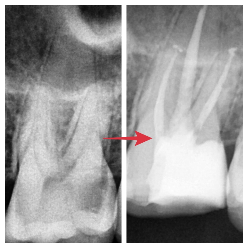 서울중구치과치료 신경치료받은 치아 크라운이 필요한가요? 관련 이미지 3