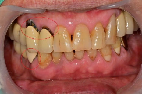 금호역 치과, 오래된 크라운을 교체 시기와 교체 시 주의해야 할 사항( 2차 충치로 인한 약해진 치아 치료) 관련 이미지 1