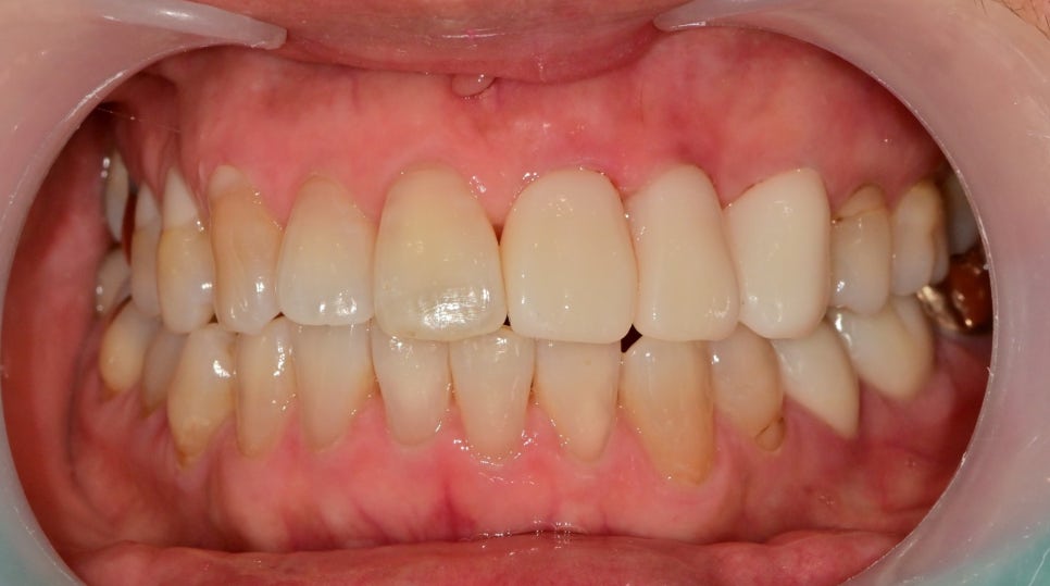 약수역 치과 오래된 앞니 크라운 재보철치료시 주의할 사항 관련 이미지 6
