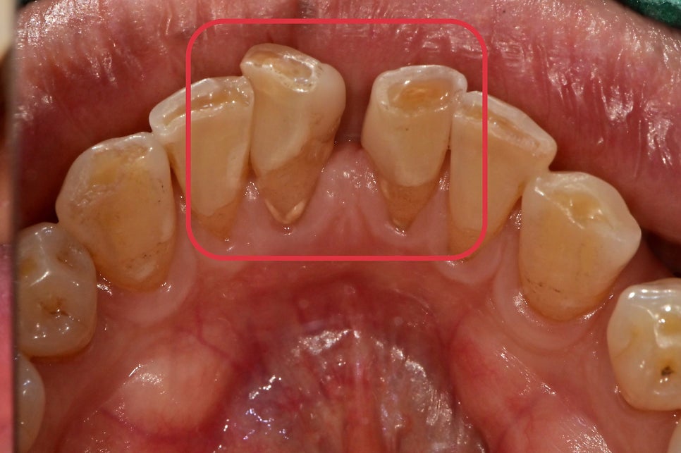 성동구 옥수동 치과 앞니 임플란트수술 즉시 임시치아 제작(구강스캐너를 이용한 수술절차) 관련 이미지 2