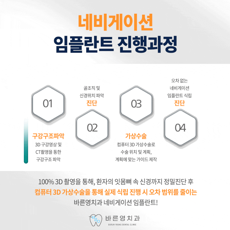 약수역치과 네비게이션 임플란트로 잃어버린 치아 대신 관련 이미지 10