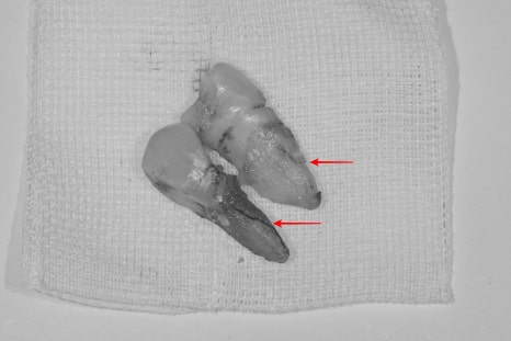 약수 임플란트, 씹을 때 갑작스러운 통증의 원인은? 관련 이미지 5