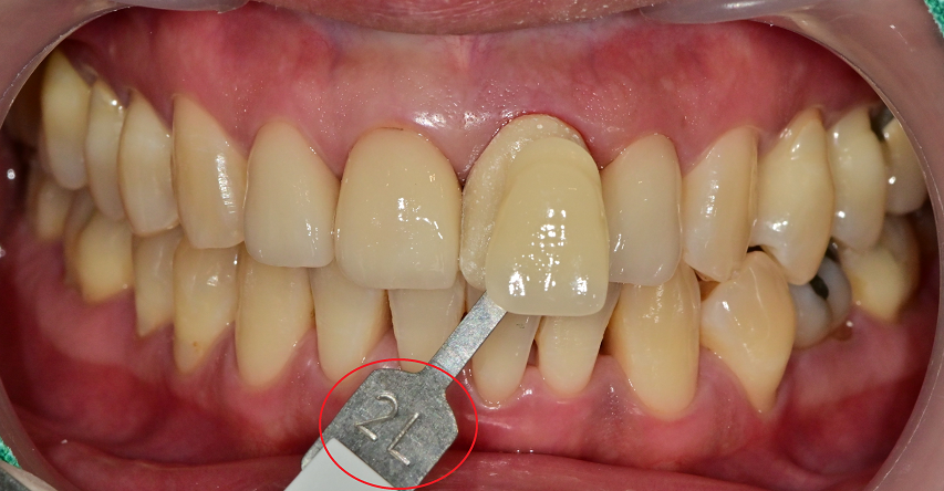 약수역 치과, 전치부 심미 보철 재치료(보철물 파절의 원인) 관련 이미지 5